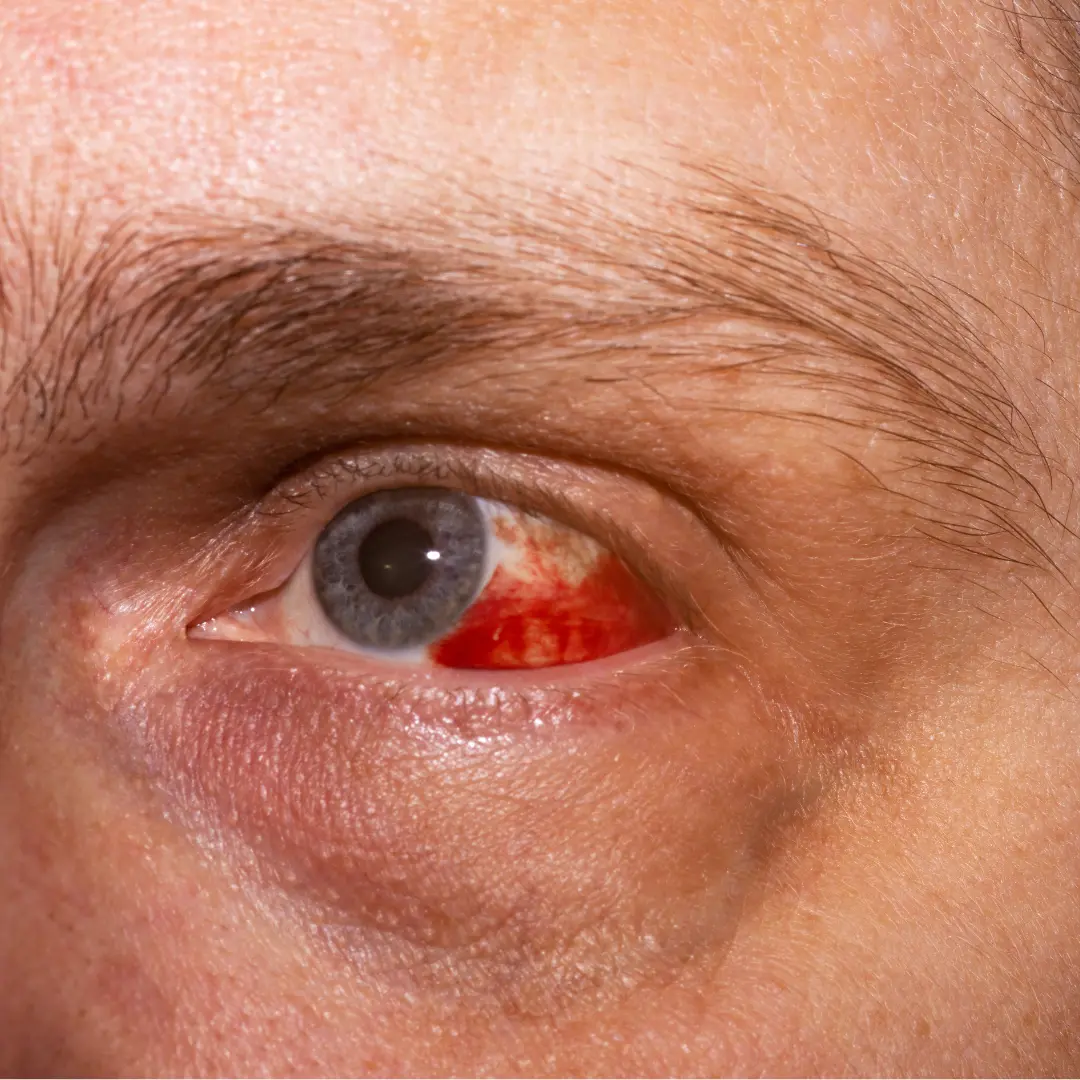 prevención lesiones oculares 2