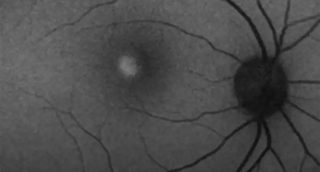prevención lesiones oculares1